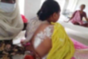 Another victim falls prey to acid violence Chithulia village of Gosaibari union, Bogura