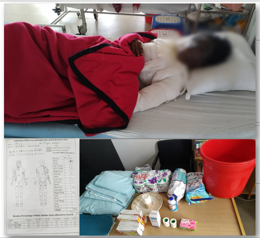 Your small contribution may help Rina begum’s early recovery: a rice mill worker burnt by acid