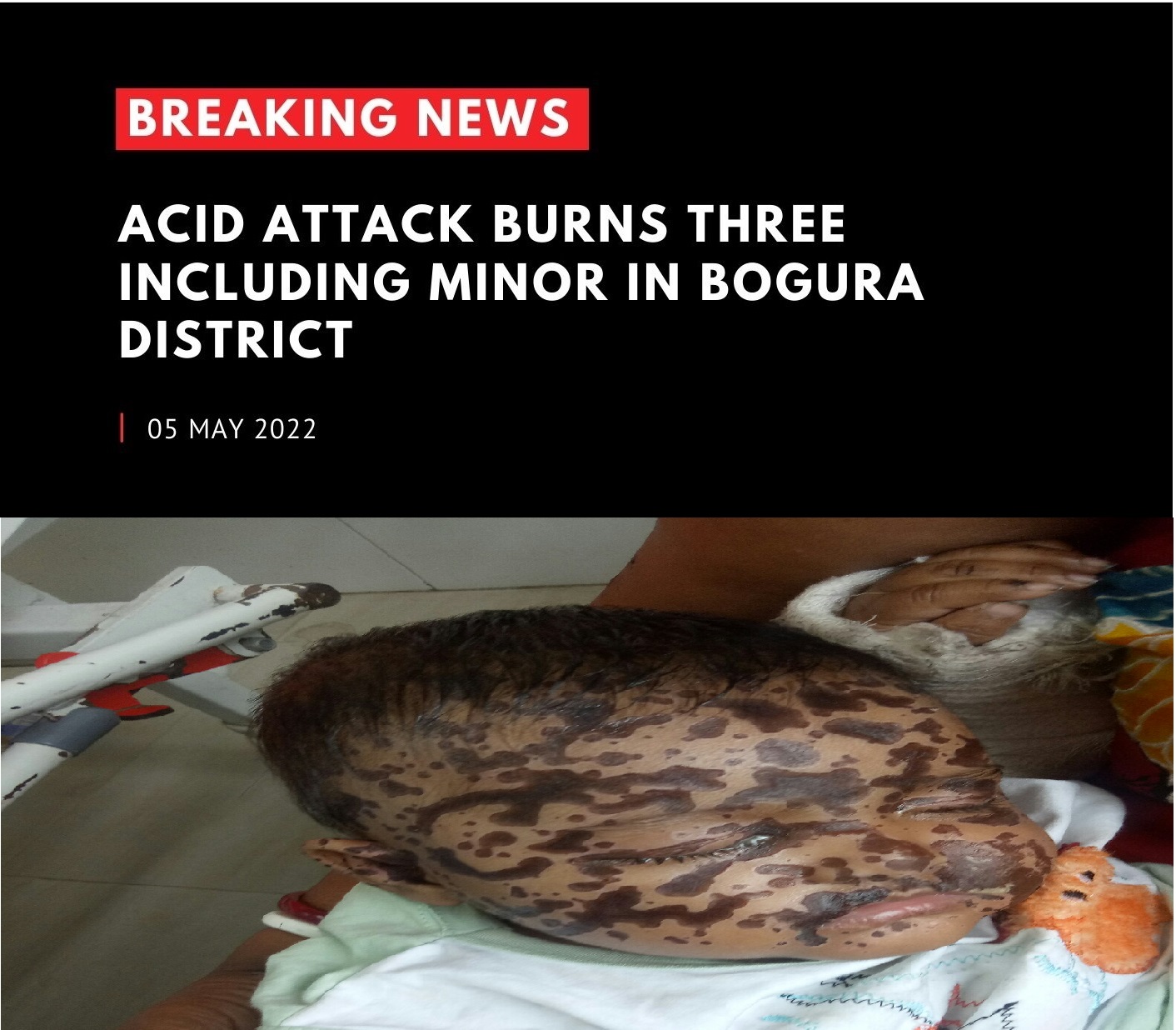 Acid attack burns three including minor in Bogra district
